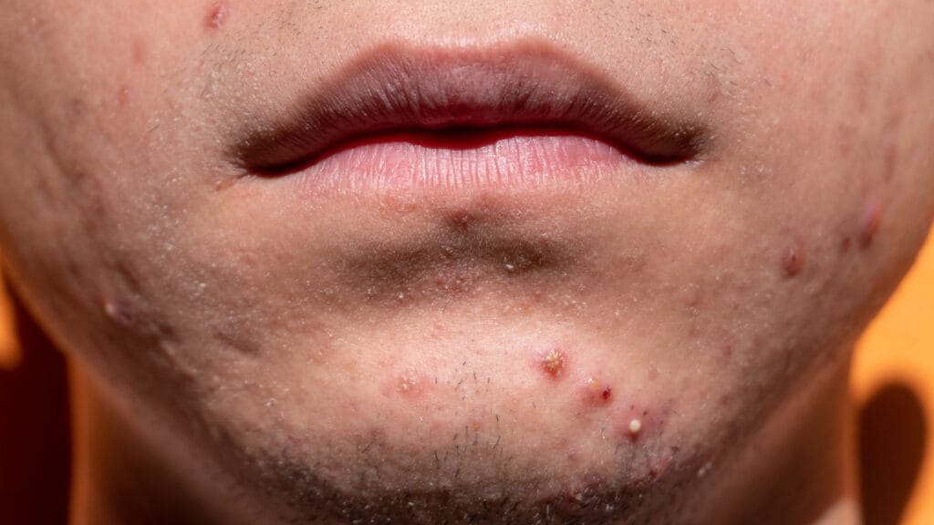 salicylic acid face wash